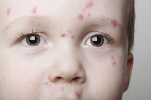 Ruam Anak? Ini Cara Bedakan Campak, Alergi, dan Cacar Air yang Sering Bikin Orang Tua Bingung